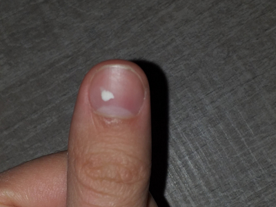 ¿Qué son las manchas blancas en las uñas y por qué aparecen?
